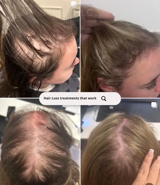 laser hair 4