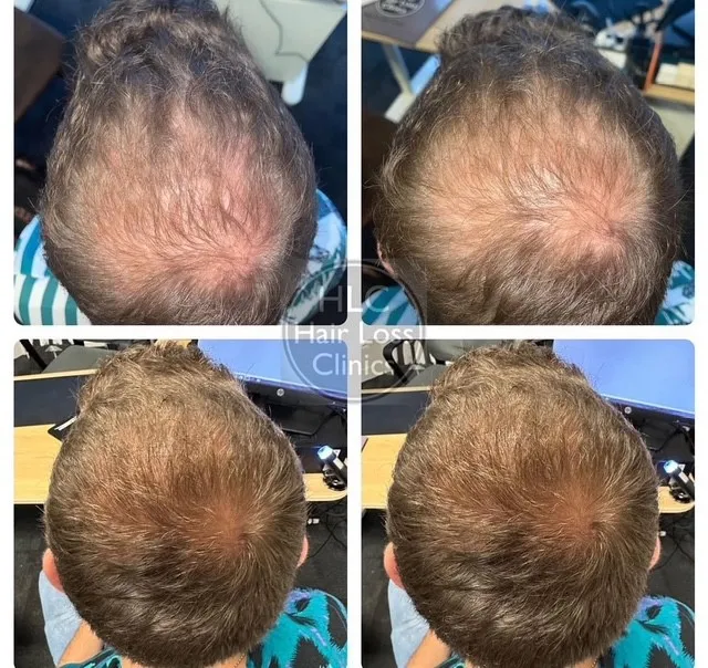 laser hair 2