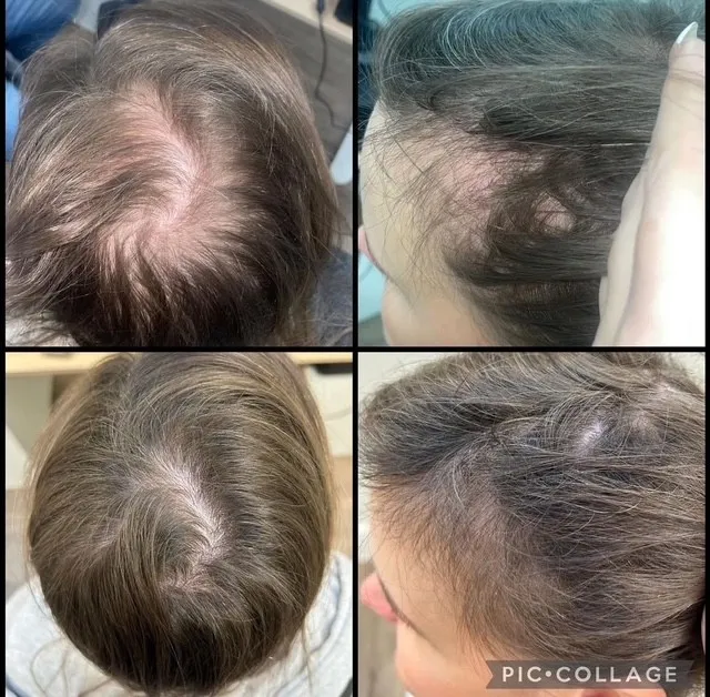 laser hair 3
