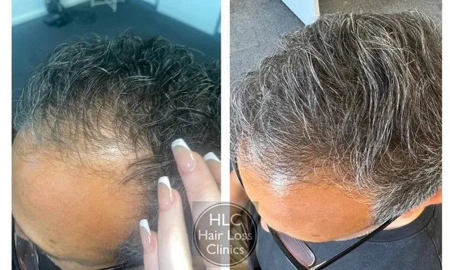 laser hair 1